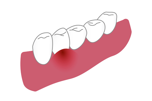 歯を失う原因第1位は歯周病