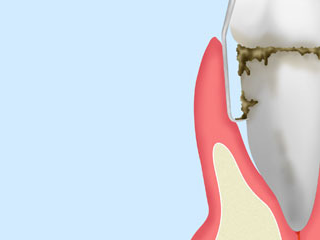 中等度歯周病「ルートプレーニング・ブラッシング指導」