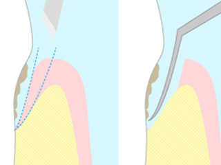 重度歯周病「歯周外科手術・ブラッシング指導」