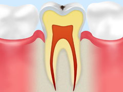 C0：初期のむし歯