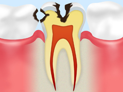 C2：象牙質のむし歯