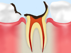 C4：歯根のむし歯