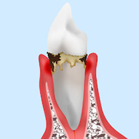 中等度の歯周炎